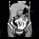 Crohn's disease, terminal ileum, stenosis, CT routine: CT - Computed tomography